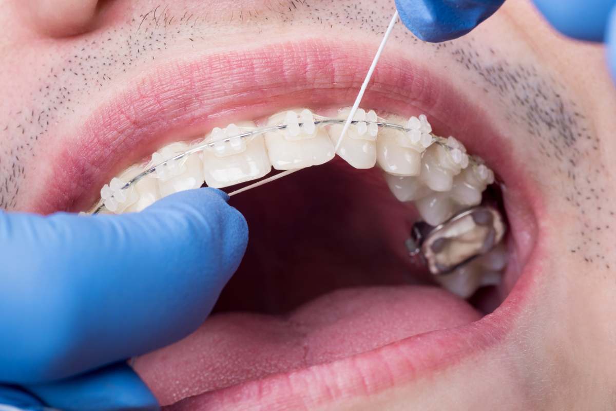 Dentist making hygiene teeth with ceramic brackets, using floss at the dental office. Macro shot of teeth with braces. Orthodontic Treatment. Oral hygiene and health care. Dentistry