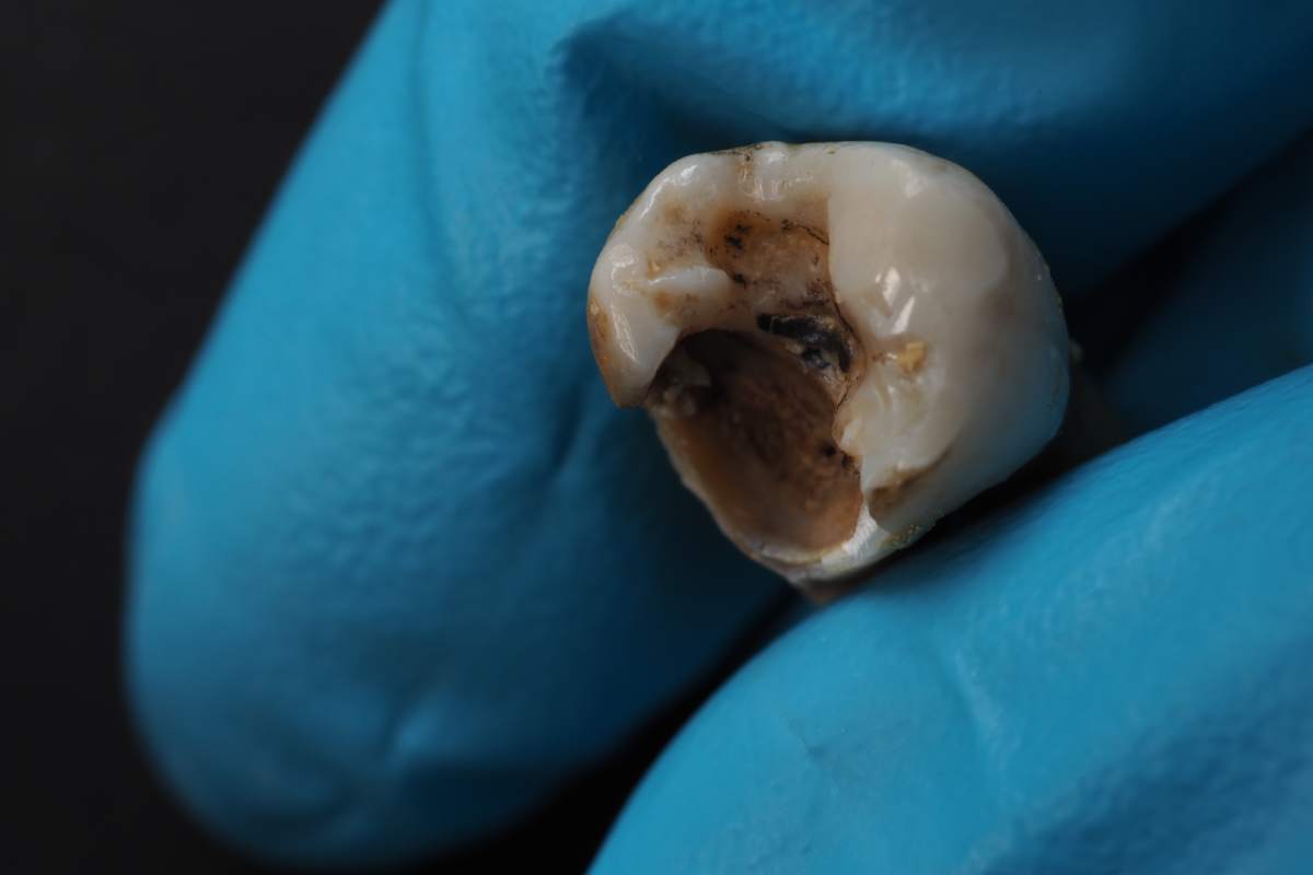 Tooth decay and dentist hand with glove and black background. Macro shot of a decayed teeth till root after extraction of dentist. Real tooth anatomy due lack of dental care. Top view of caries teeth